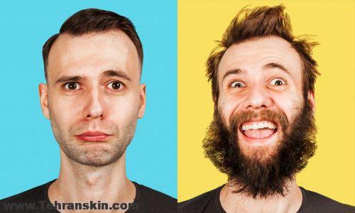 کاشت مو در ساری