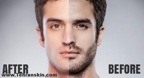 شایعات لیزر