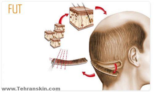 روش های کاشت مو  (FUT)