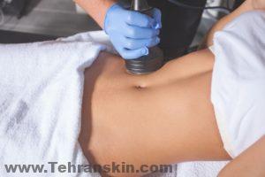 تتم إزالة الجلد المترهل والدهون الزائدة ويمكن للإجراء (الإجراءات) أن يحسن سطح الجلد الخافت وغير المنتظم.