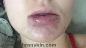 خطرات و عوارض جانبی تزریق ژل و چربی به لب