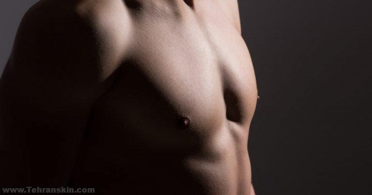 لیزر موهای زائد برای مردان