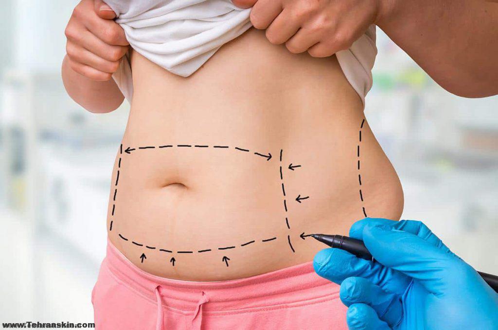 هزینه عمل لیپوست