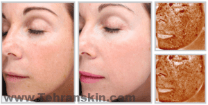 يمكن أن يخفف تجديد سطح الجلد بالليزر ، من تجاعيد الوجه والندبات والعيوب