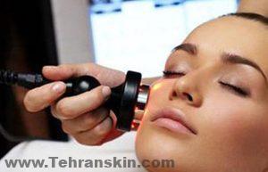 مزایای استفاده از روش IPL