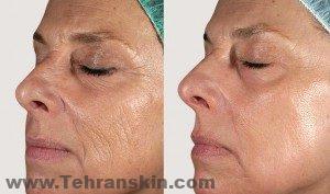 ما هي النتائج التي يجب أن أتوقعها بعد تجديد سطح الجلد بالليزر ؟