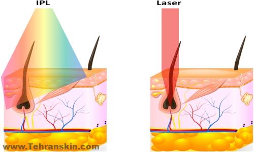 لیزر کردن موهای زائد بدن