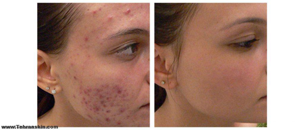 پاکسازی و لایه برداری صورت با میکرودرم ابریژن