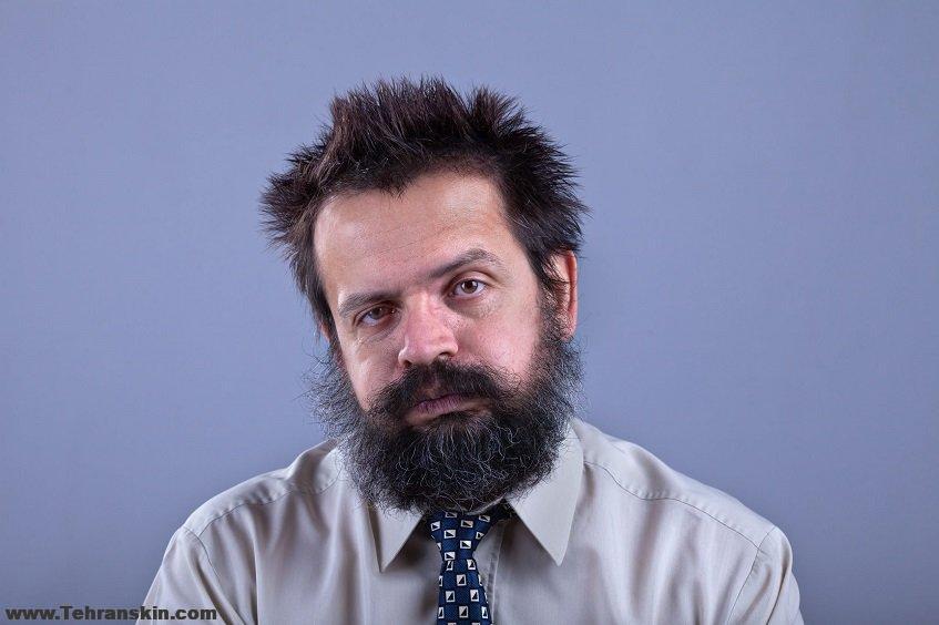 نکات مهم کاشت ریش