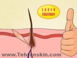 لیزر موهای زائد صورت | هزینه ی لیزر موهای زائد صورت aid22741 v4 728px Get the Most Benefit from Laser Hair Removal Step 1 Version 3 300x225 1 - لیزر موهای زائد صورت | هزینه ی لیزر موهای زائد صورت