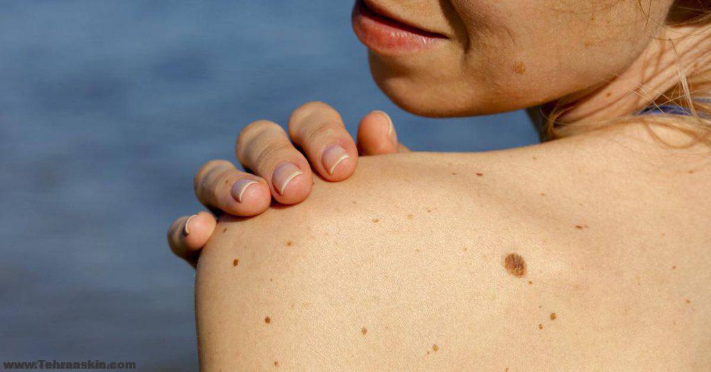 لیزر موهای زائد روی خال