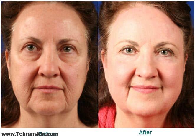 تسطيح الليزر ، مما يتيح الدقة القصوى ، خاصة في المناطق الحساسة. ما ليزر تجديد سطح الجلد يمكن أن تحسن : • الخطوط الدقيقة أو التجاعيد حول أو تحت عينيك ، الجبهة أو الفم