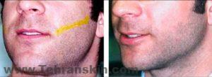 لیزر موهای زائد آقایان | هزینه لیزر کل بدن مردان hairremoval ba 2 300x110 - لیزر موهای زائد آقایان | هزینه لیزر کل بدن مردان