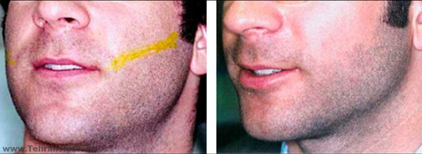 لیزر موهای زائد آقایان | هزینه لیزر کل بدن مردان hairremoval ba 2 - لیزر موهای زائد آقایان | هزینه لیزر کل بدن مردان