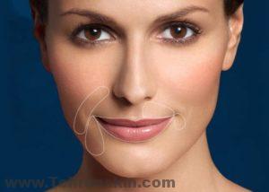 خط خنده را چگونه از بین ببریم؟| درمان قطعی خط خنده how to get rid of wrinkles around mouth 1 300x214 - خط خنده را چگونه از بین ببریم؟| درمان قطعی خط خنده