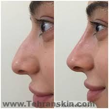 یک روش عالی برای صاف کردن بینی