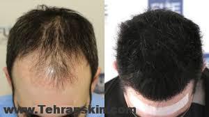 کاشت موی سر آقایان