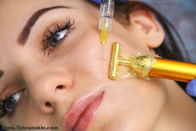 در مرکز کرج از چه پرکننده ای استفاده می کنیم؟  