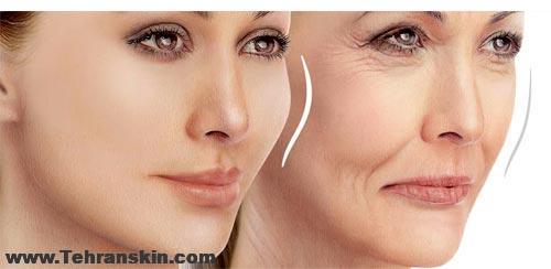 نکات مهم پس از لیفت گونه در اراک