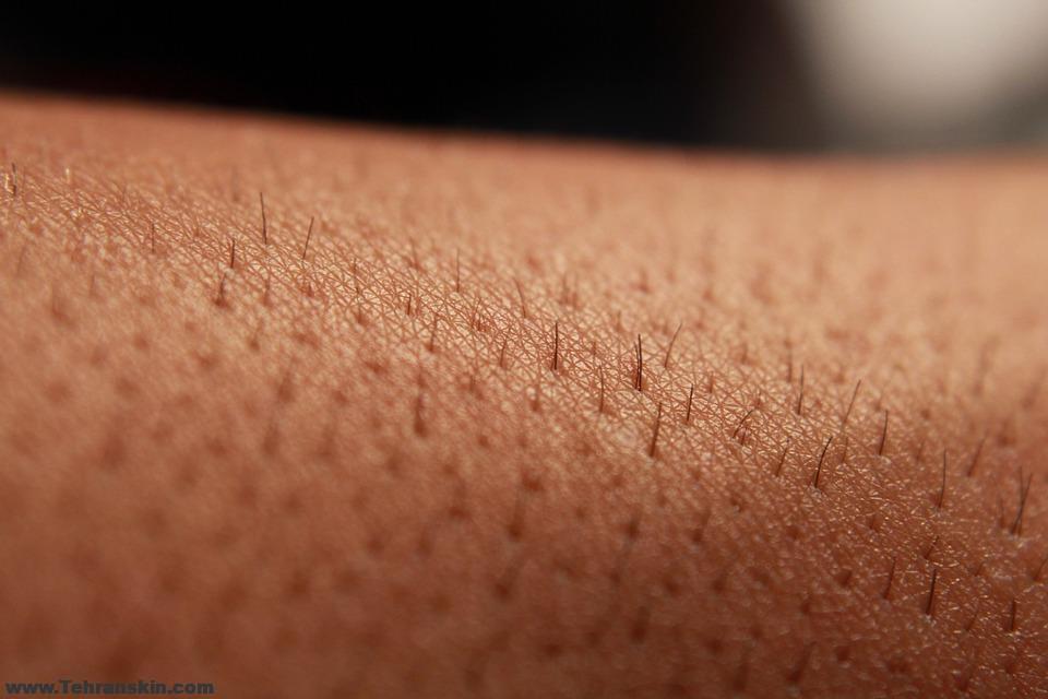 جلسات ترمیمی لیزر موهای زائد