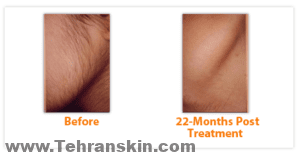 لیزر موهای زائد صورت | هزینه ی لیزر موهای زائد صورت laser assisted hair removal3 300x157 - لیزر موهای زائد صورت | هزینه ی لیزر موهای زائد صورت