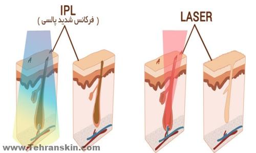 لیزر خوب در ساری