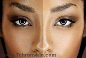 المرضى الذين يعانون من لون البشرة الداكن