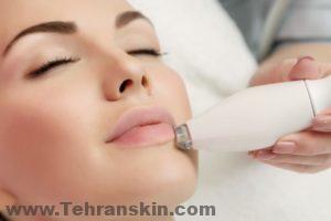 خط خنده را چگونه از بین ببریم؟| درمان قطعی خط خنده magMicroneedlingImage1 300x200 - خط خنده را چگونه از بین ببریم؟| درمان قطعی خط خنده