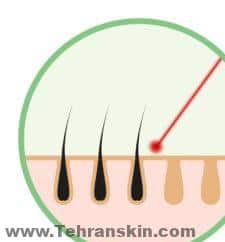 لیزر اهواز نی نی سایت