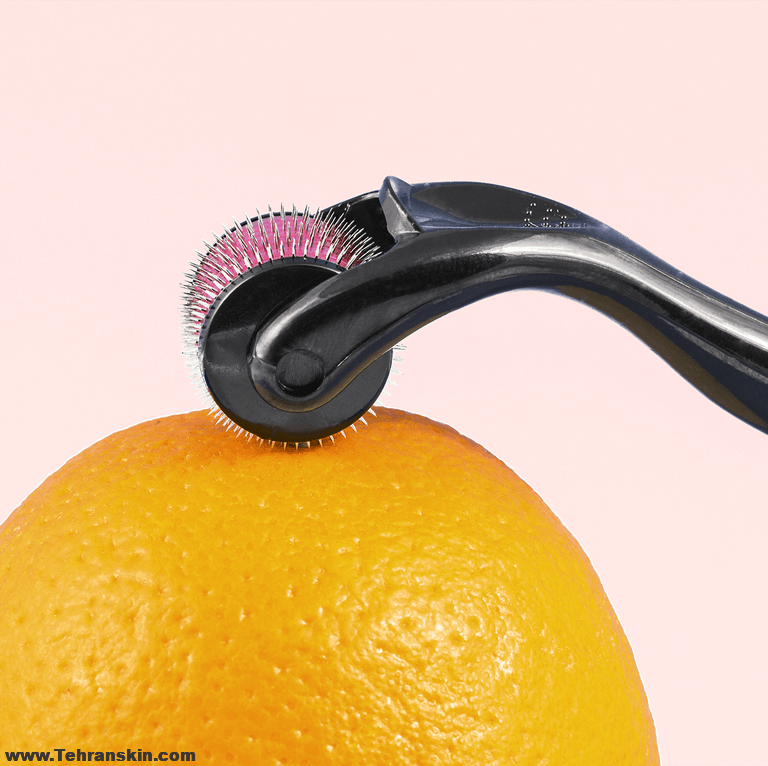 بعد از میکرونیدلینگ چه اتفاقی می افتد