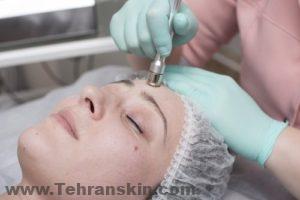 ما هو عملية تسحيج الجلد ؟