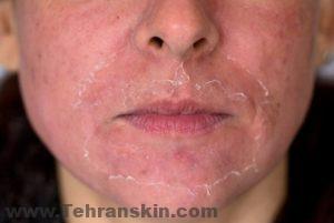 ما هي مخاطر التقشير السطحي ؟