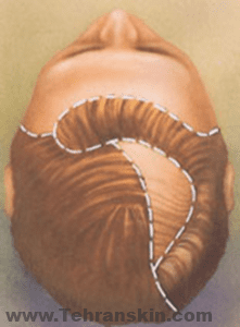 عندما يمتد الجلد الموجود تحت الشعر بدرجة كافية ، فإنه يتم وضعه جراحياً على منطقة الصلع.