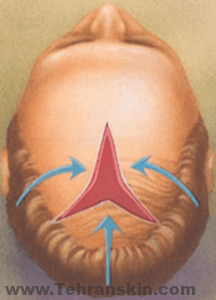 تختلف الأنماط المستخدمة في الحد من فروة الرأس على نطاق واسع ، ومع ذلك تلبي جميعها الهدف المتمثل في الجمع بين الشعر وفروة الرأس لتغطية مناطق الصلع.