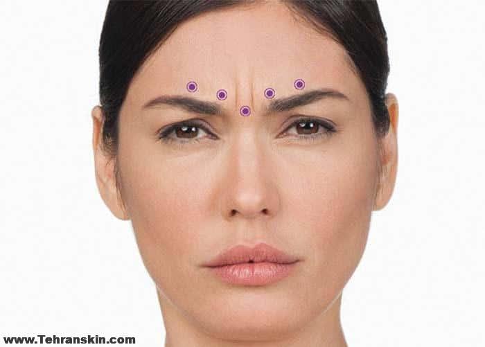 هزینه بوتاکس پیشانی در شیراز