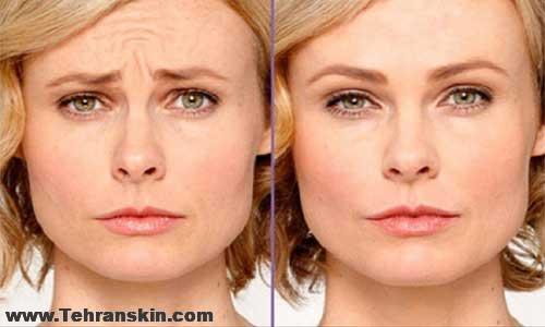 بوتاکس پیشانی