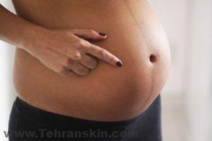 تیره شدن پوست در بارداری