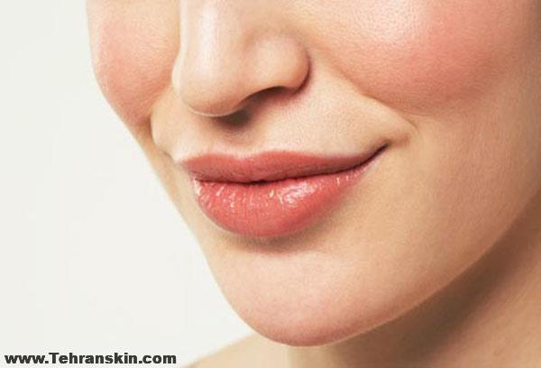 رفع خط لبخند با تزریق فیلر