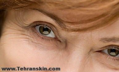 رفع خطوط پا کلاغی با بوتاکس