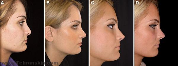 عکس قبل و بعد از تزریق ژل به بینی