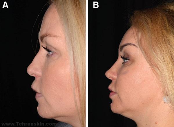 عکس قبل و بعد از تزریق ژل بینی