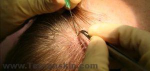 ما الذي يجب أن أتوقعه خلال عملية استعادة زراعة الشعر؟