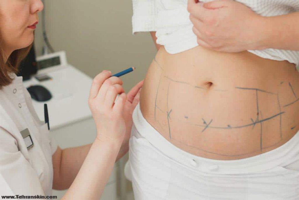 معلومات كاملة عن شفط الدهون وتحلل الدهون