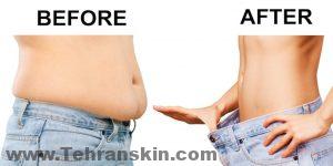 شفط الدهون قبل وبعد الصور