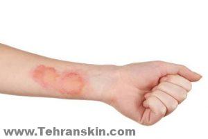 إزالة الشعر عن طريق الليزر يمكن أن يسبب تهيج مؤقت. قد تلاحظ أيضًا احمرارًا خفيفًا وتورمًا في المنطقة المعالجة.