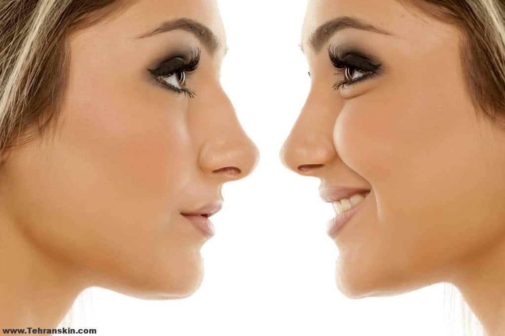 جراحی رینوپلاستی