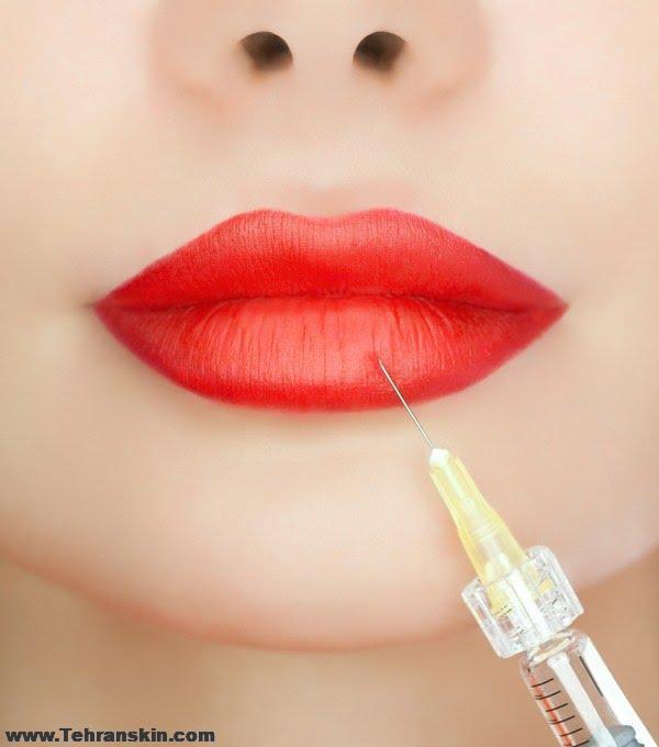 تزریق ژل لب