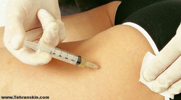 لاغری موضع با مزوتراپی