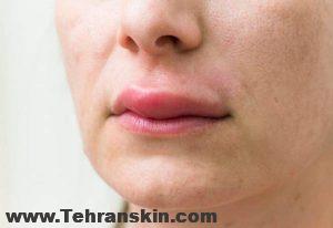 مراقبت های بعد از تزریق ژل لب | بعد از تزریق ژل لب چه باید کرد؟ 300x206 - مراقبت های بعد از تزریق ژل لب | بعد از تزریق ژل لب چه باید کرد؟