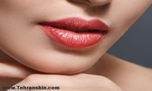 تزریق ژل لب در اصفهان